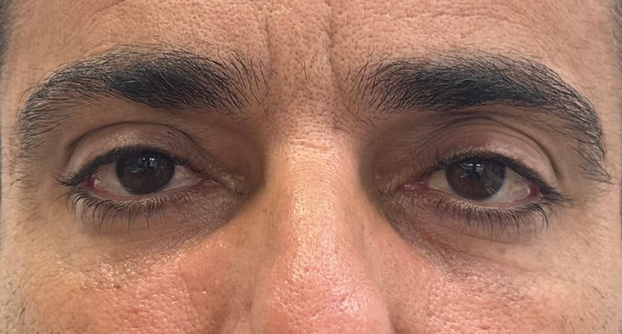 ניתוח עפעפיים תחתונים אחרי הניתוח