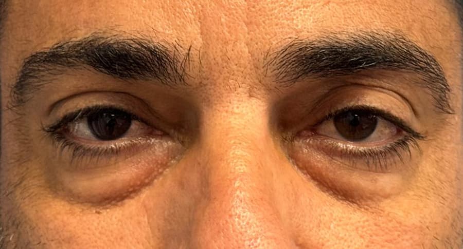 ניתוח עפעפיים תחתונים לפני הניתוח