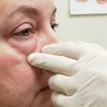 נפיחות בעפעף התחתון