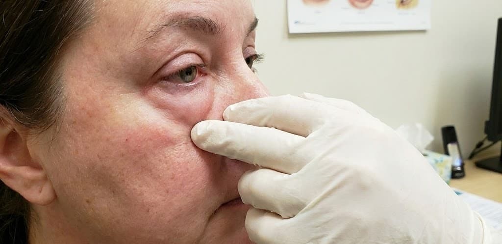 נפיחות בעפעף התחתון