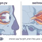 אקסופתלמוס