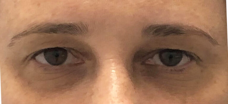 upper eyelids-pre10
